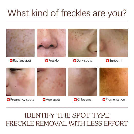 Spots Peel off Facial Mask Freckle Pigmentation Removal Cream - Amaan